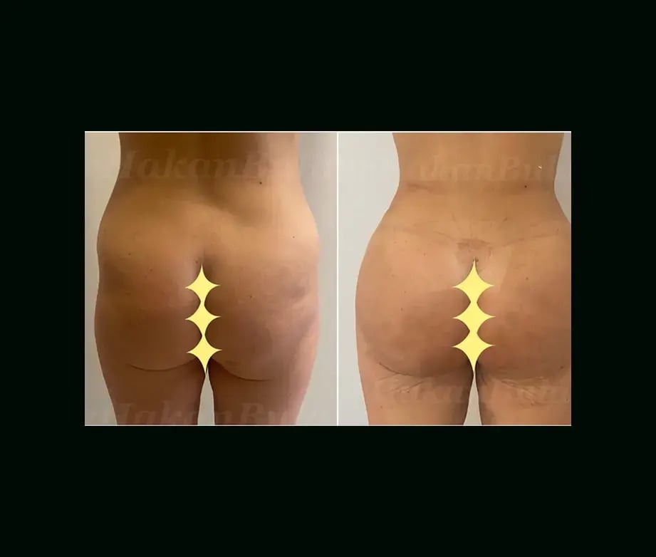 hakan-bulam-md-bbl-before-after-2