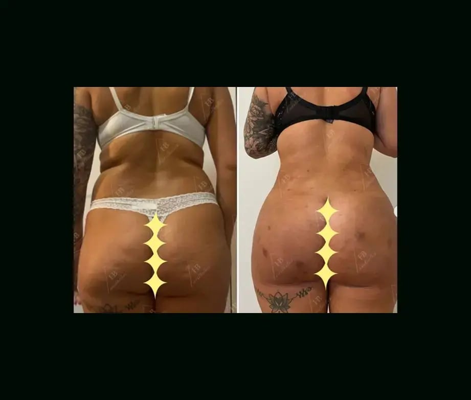 hakan-bulam-md-bbl-before-after-3