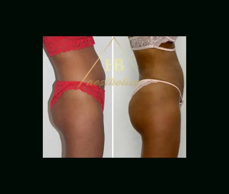 hakan-bulam-md-bbl-before-after-4