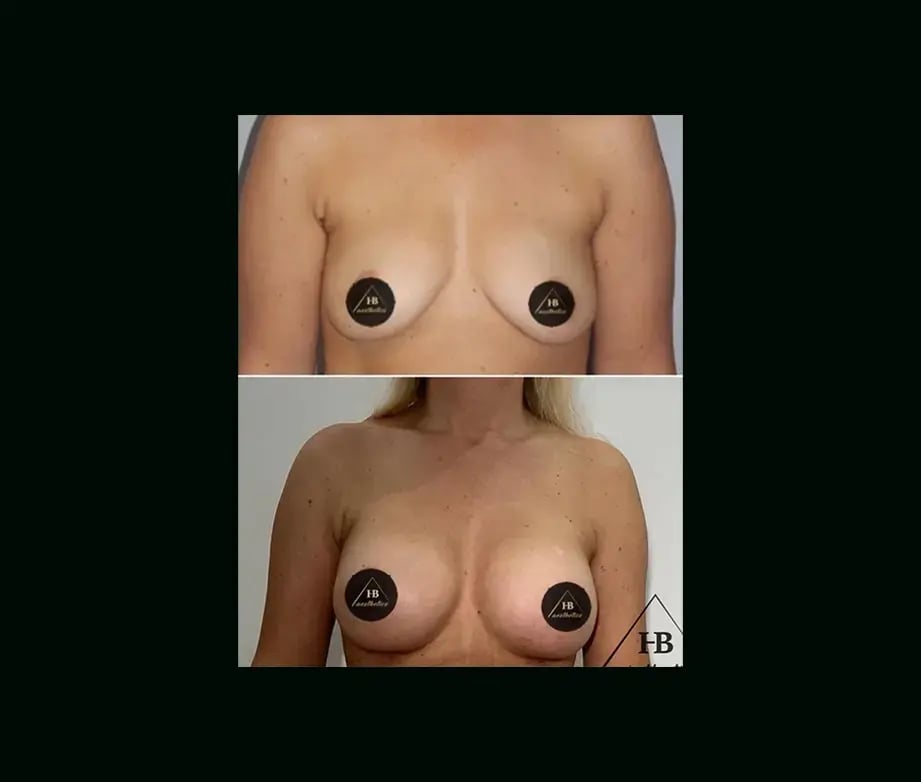 hakan-bulam-md-breast-augmentation-before-after-1-1