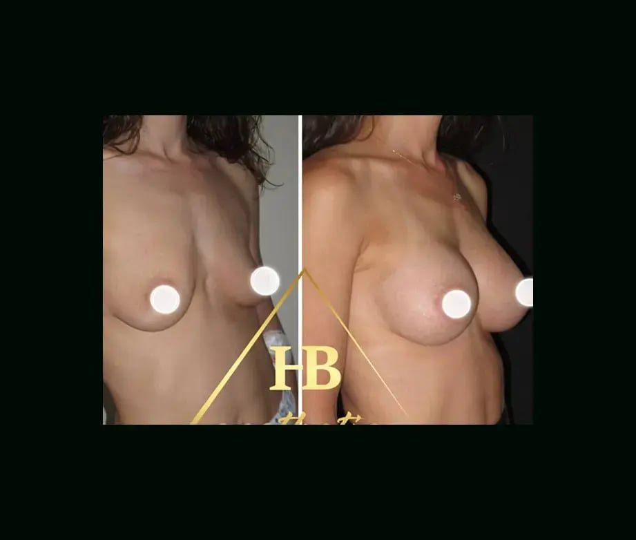 hakan-bulam-md-breast-augmentation-before-after-7-2