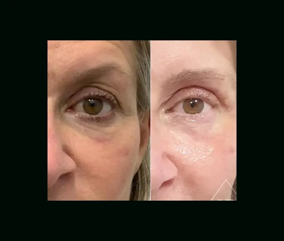 hakan-bulam-md-eyelid-before-after-1-1