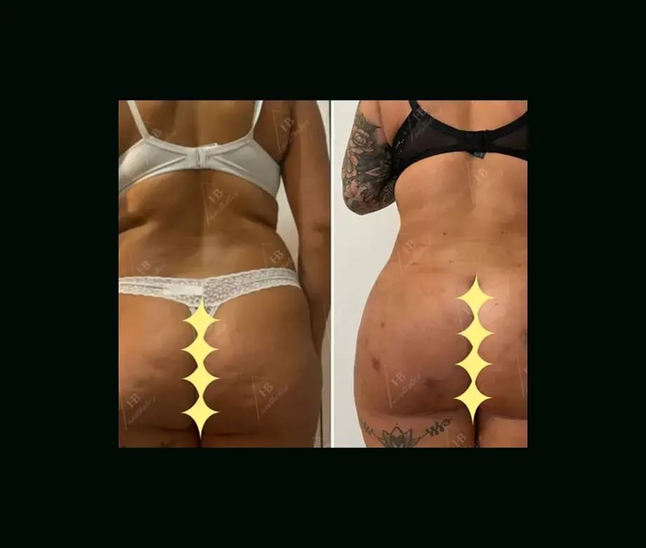 hakan-bulam-md-liposuction-before-after-2-2