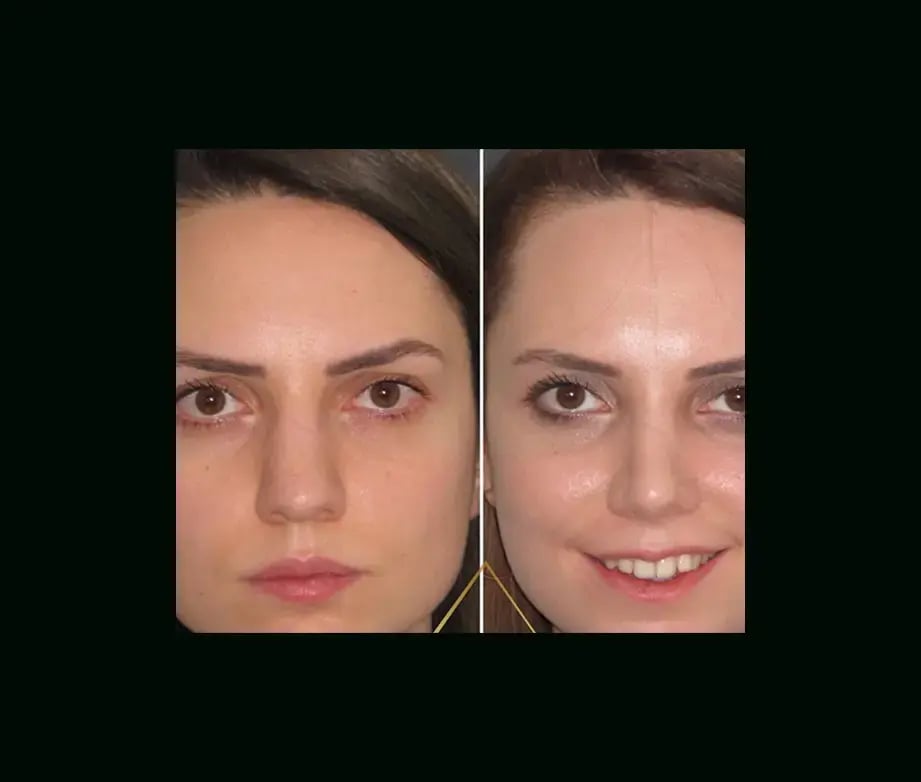 hakan-bulam-md-rhinoplasty-before-after-2-2