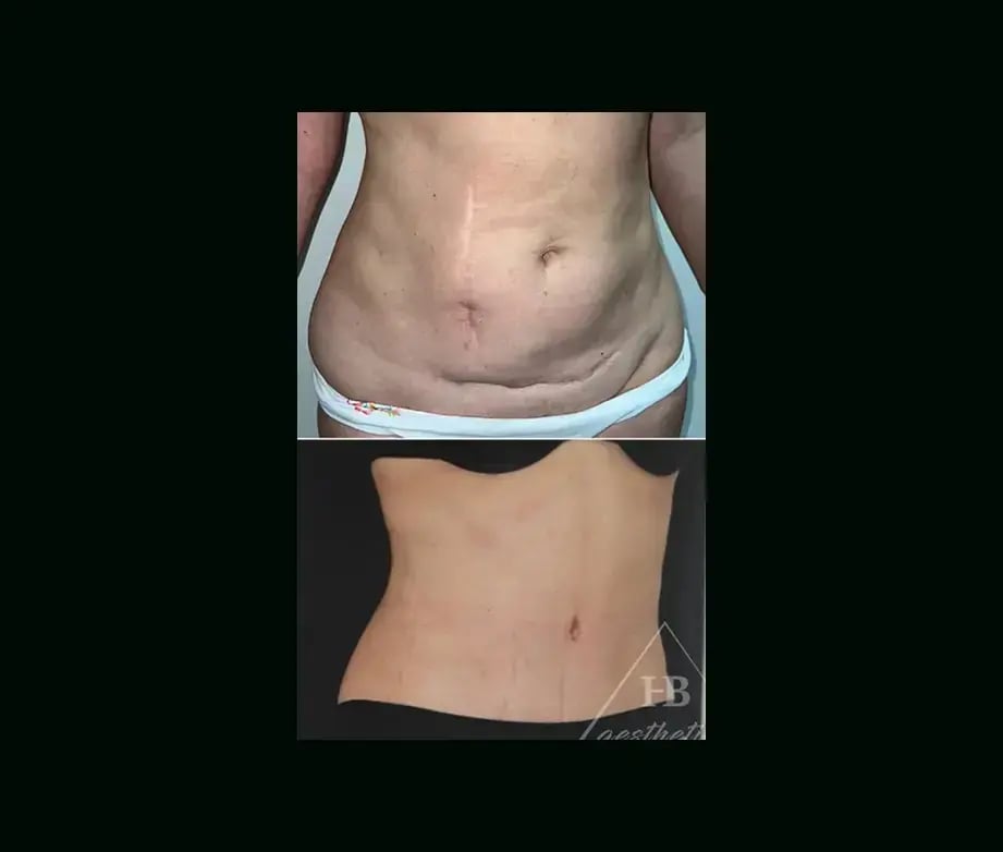hakan-bulam-md-tummy-tuck-before-after-1-2