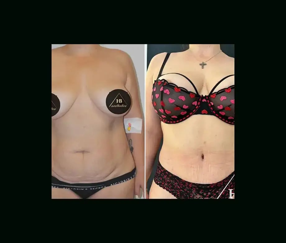 hakan-bulam-md-tummy-tuck-before-after-2-2