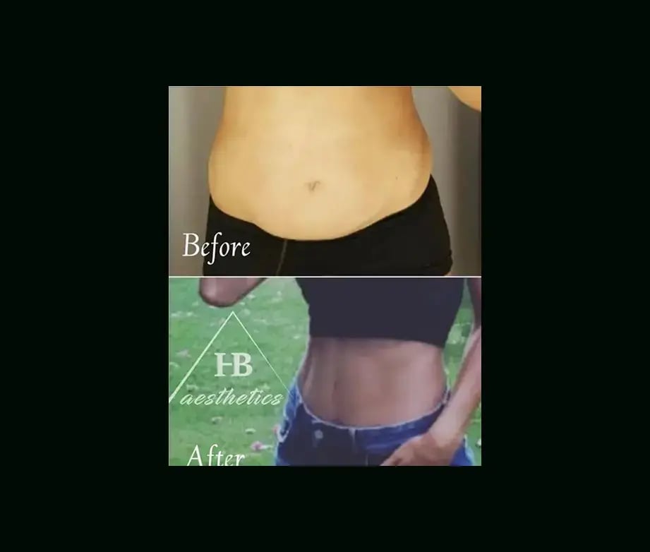 hakan-bulam-md-tummy-tuck-before-after-3-2