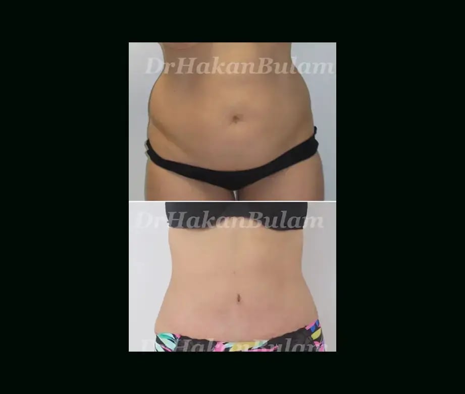 hakan-bulam-md-tummy-tuck-before-after-5-1