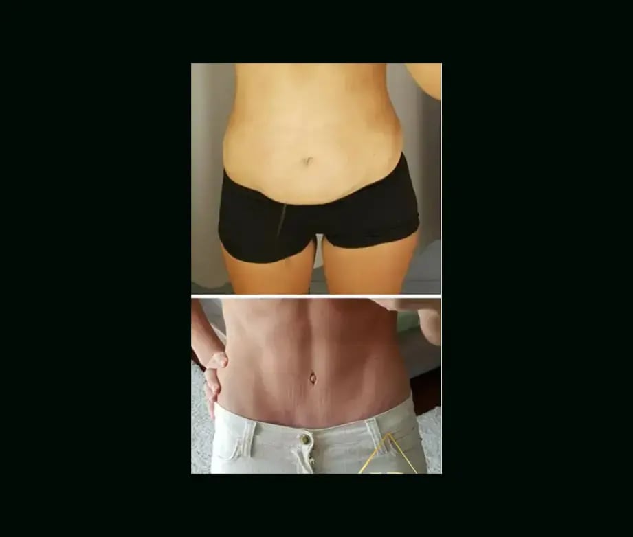hakan-bulam-md-tummy-tuck-before-after-6-2