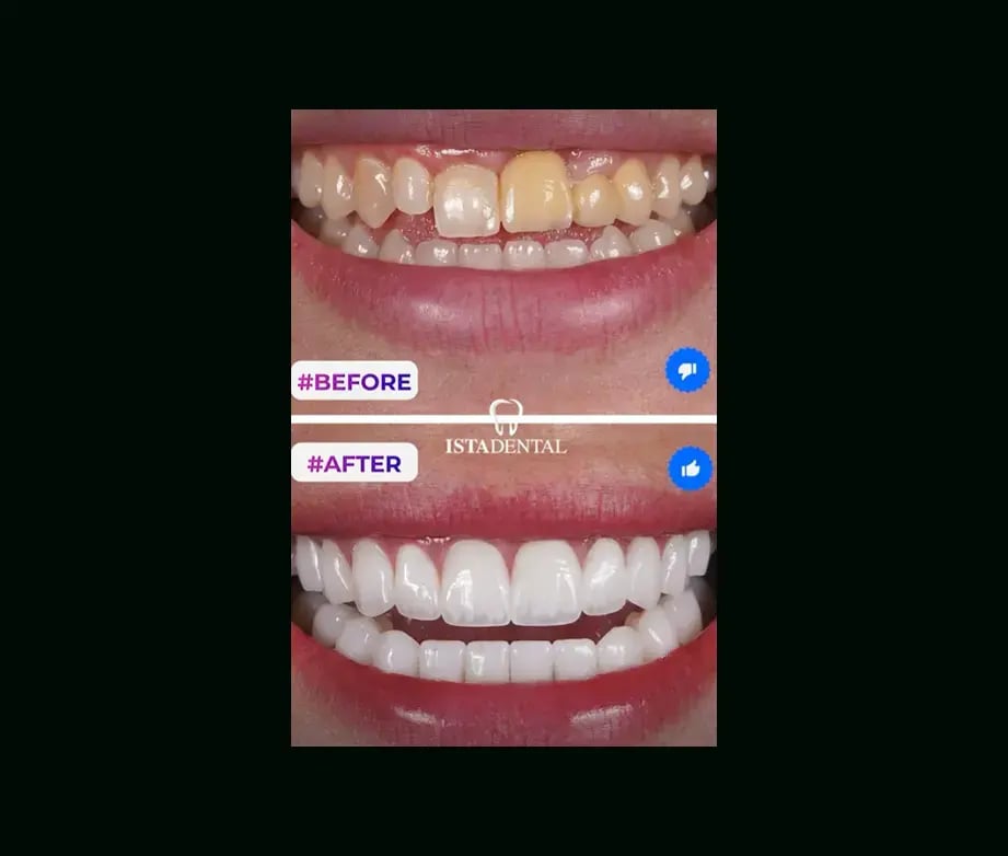 istadental-before-after-18