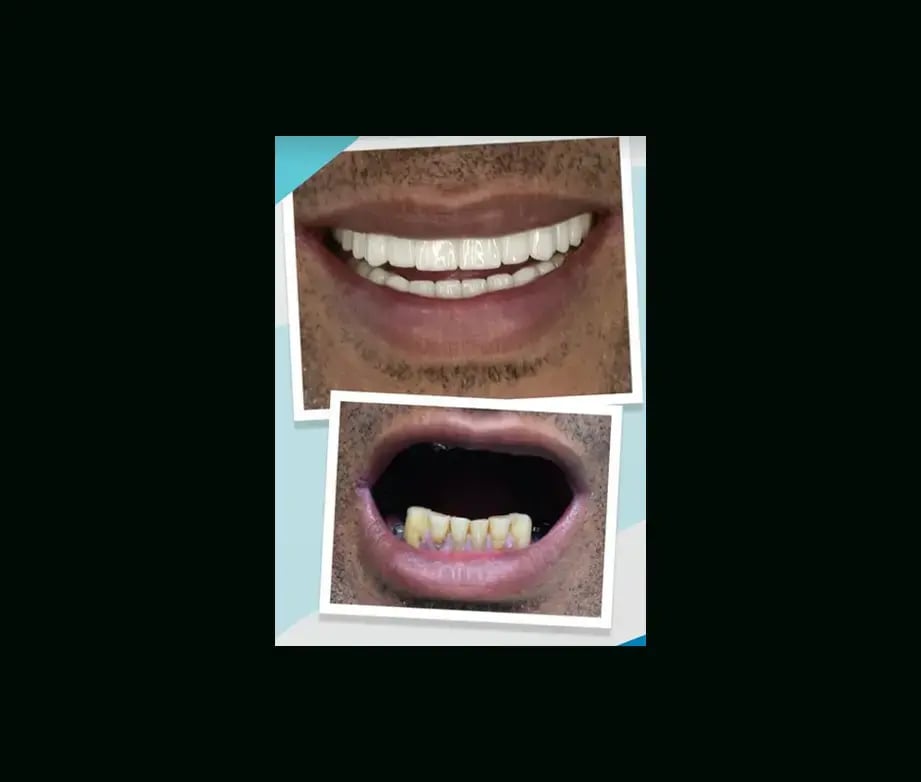 istadental-before-after-4