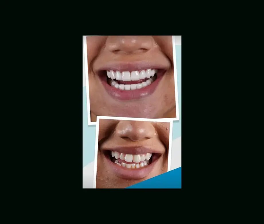 istadental-before-after-6