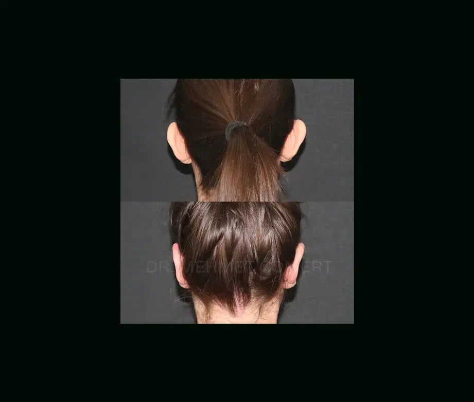 mehmet-comert-md-ear-surgery-before-after-1