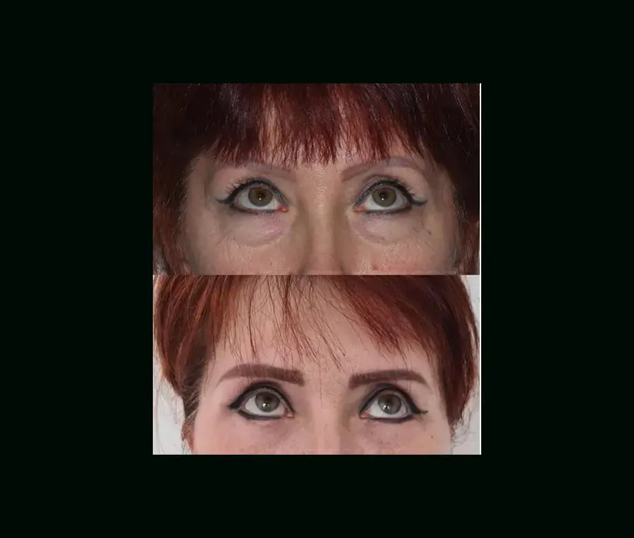 mehmet-comert-md-eyelid-before-after-1-1