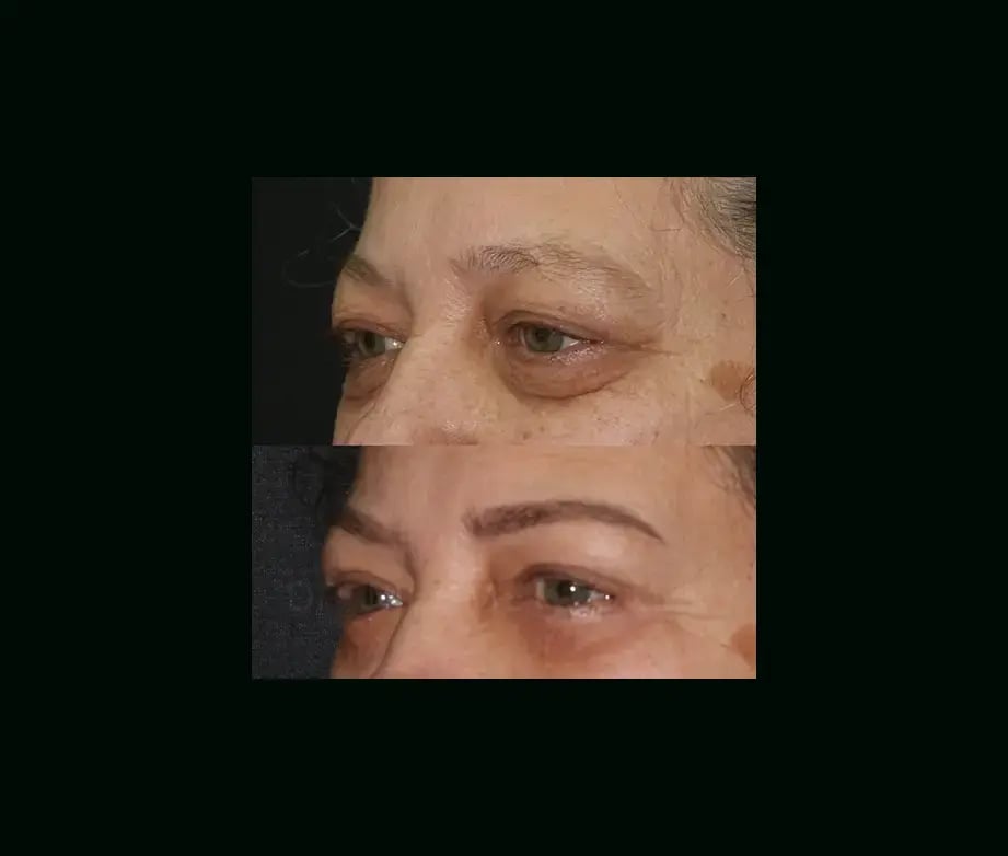 mehmet-comert-md-eyelid-before-after-2-1
