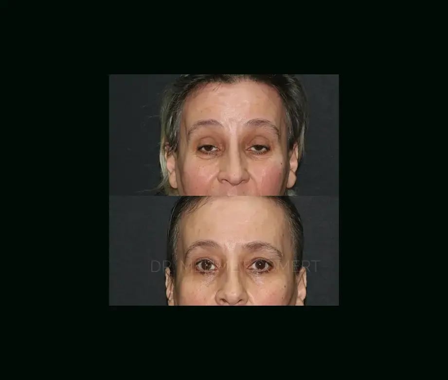 mehmet-comert-md-eyelid-before-after-3-1