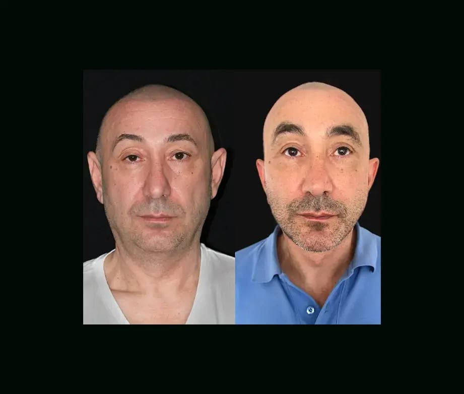 mehmet-comert-md-face-lift-before-after-1-2