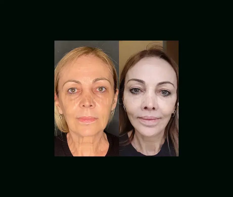 mehmet-comert-md-face-lift-before-after-10-1