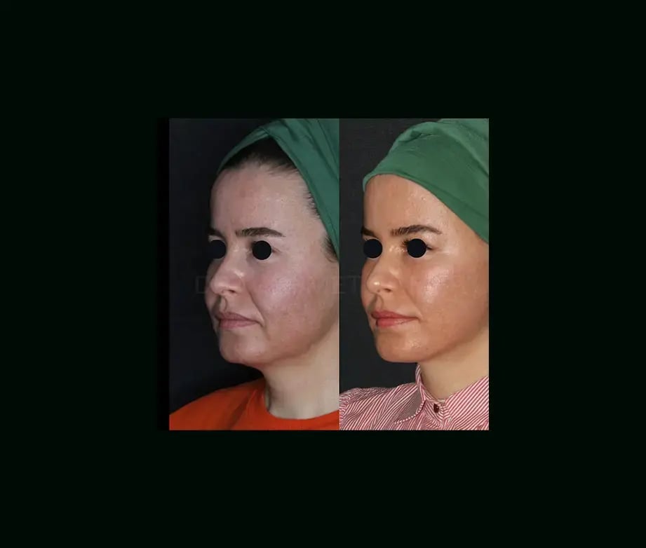 mehmet-comert-md-face-lift-before-after-11