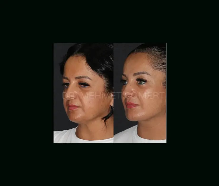 mehmet-comert-md-face-lift-before-after-12-1