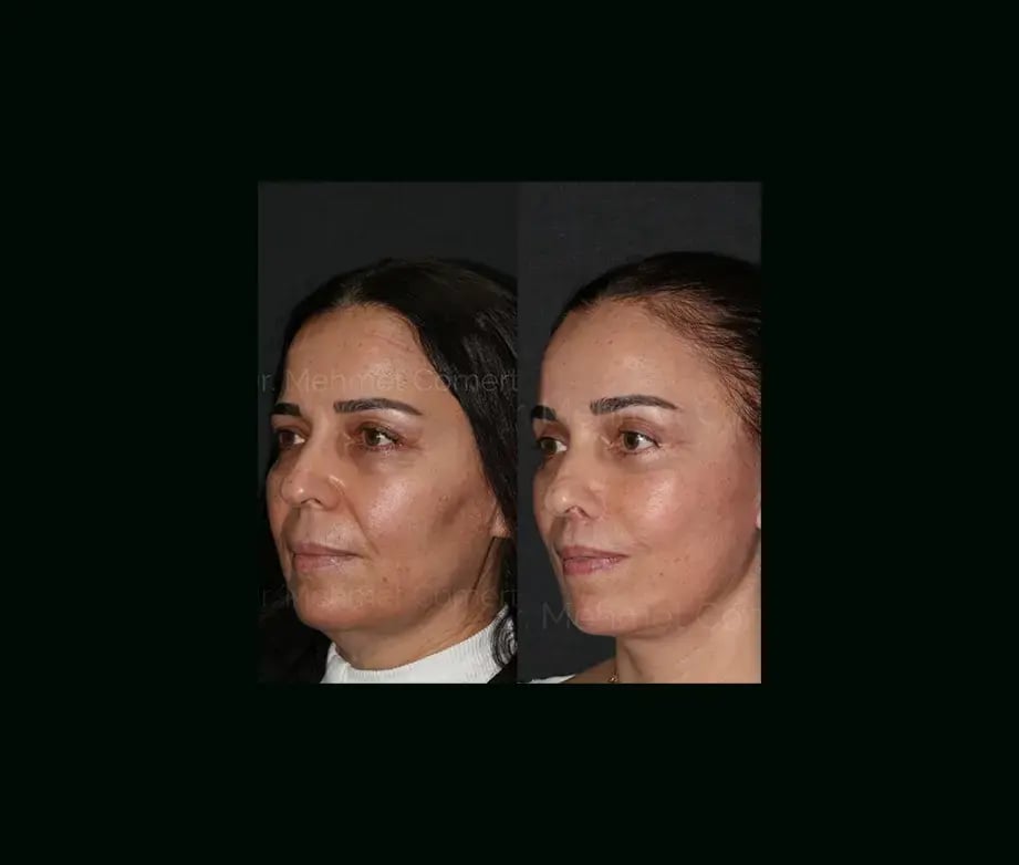 mehmet-comert-md-face-lift-before-after-13-1