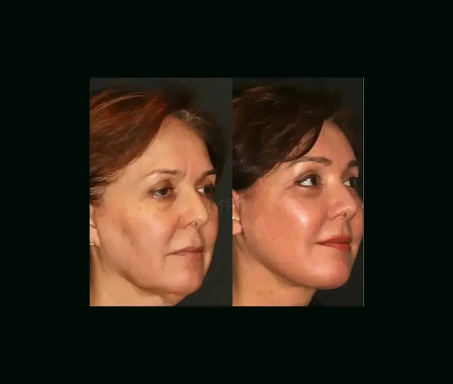 mehmet-comert-md-face-lift-before-after-15-1