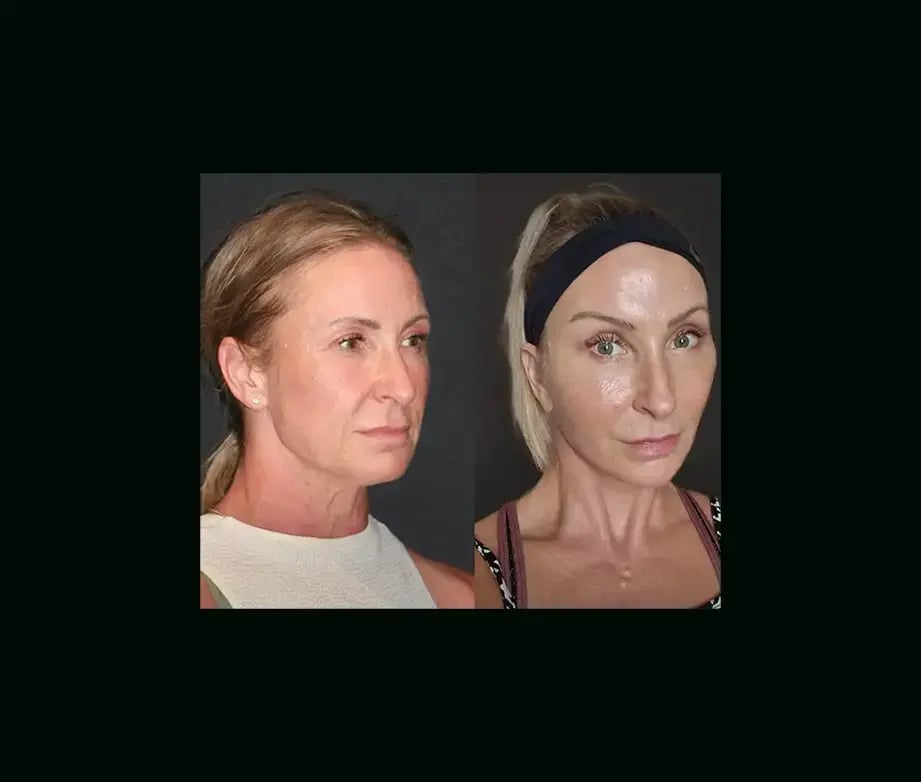 mehmet-comert-md-face-lift-before-after-16-1