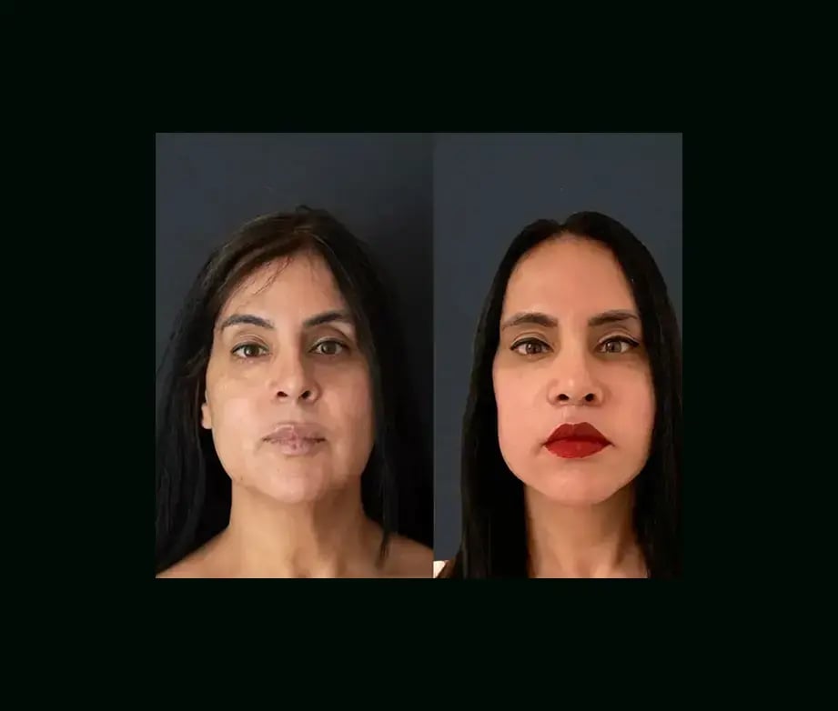 mehmet-comert-md-face-lift-before-after-17-2