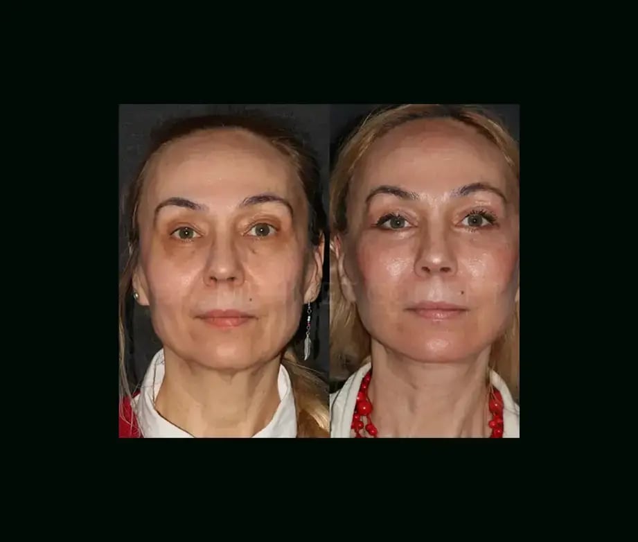 mehmet-comert-md-face-lift-before-after-18-1