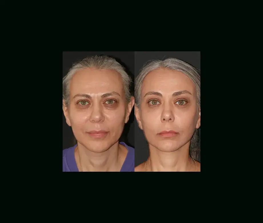 mehmet-comert-md-face-lift-before-after-2-2