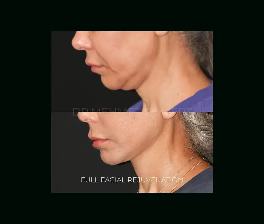mehmet-comert-md-face-lift-before-after-20