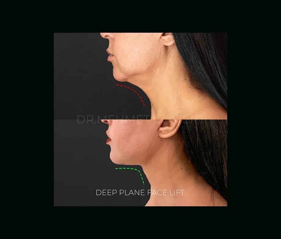 mehmet-comert-md-face-lift-before-after-21