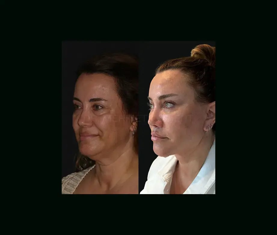 mehmet-comert-md-face-lift-before-after-22