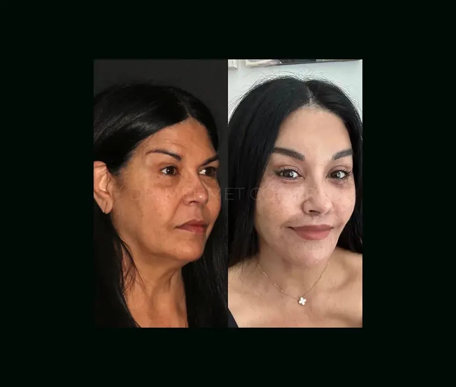 mehmet-comert-md-face-lift-before-after-23