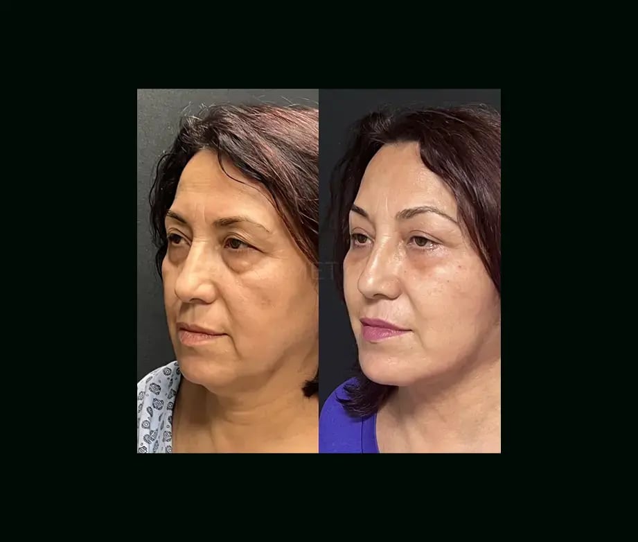 mehmet-comert-md-face-lift-before-after-24