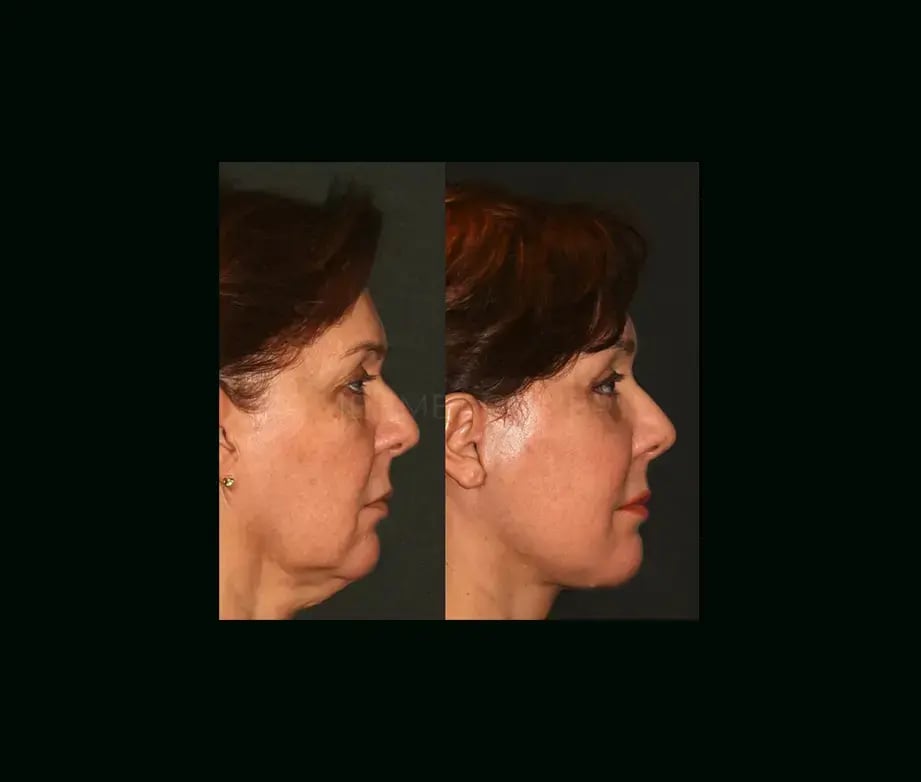 mehmet-comert-md-face-lift-before-after-3-2
