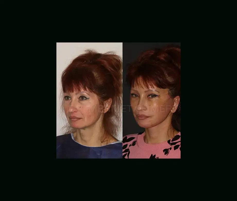 mehmet-comert-md-face-lift-before-after-4-2