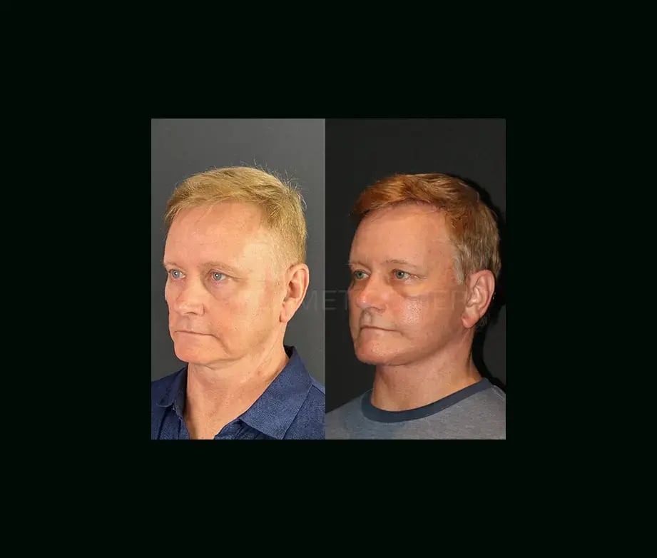 mehmet-comert-md-face-lift-before-after-5-2