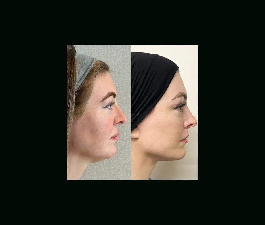mehmet-comert-md-face-lift-before-after-6-1