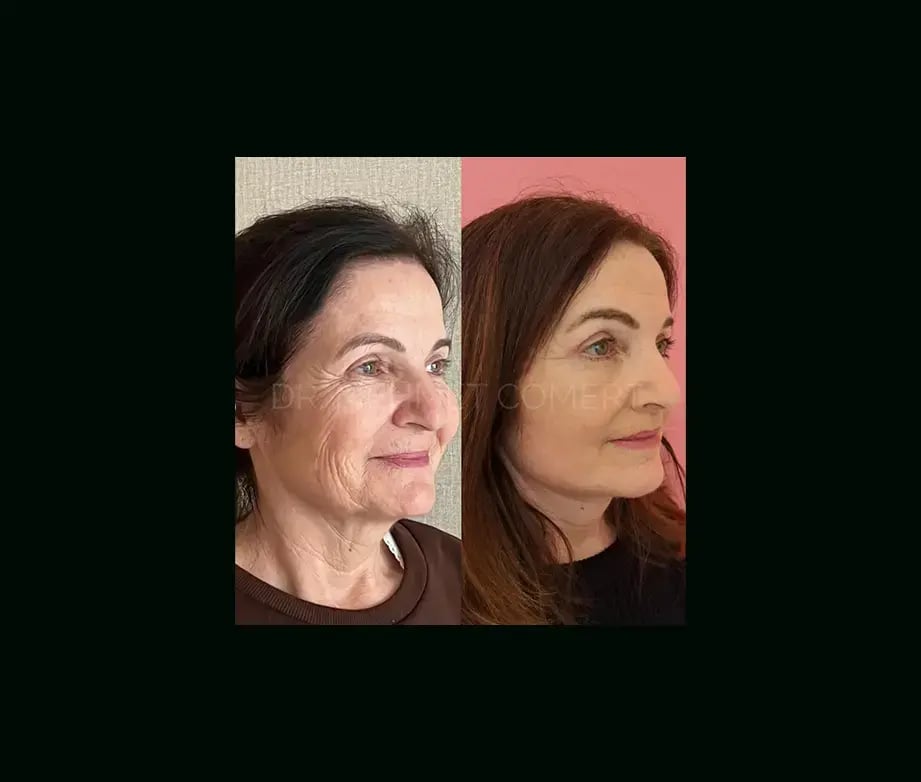 mehmet-comert-md-face-lift-before-after-7-1