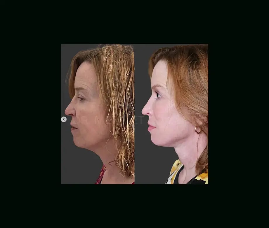 mehmet-comert-md-face-lift-before-after-8-1