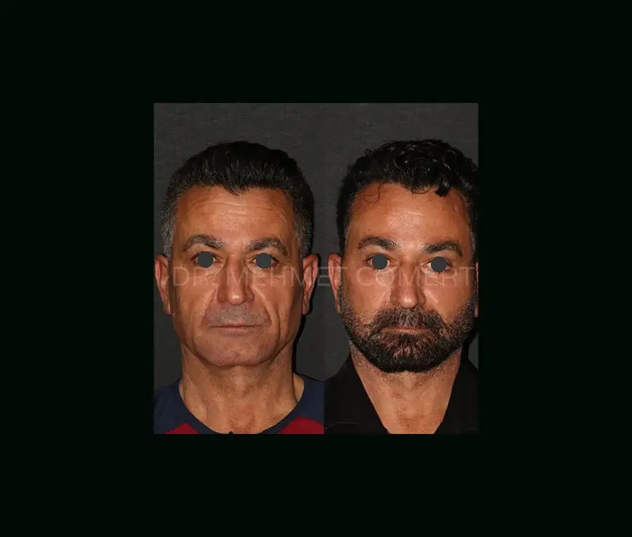 mehmet-comert-md-face-lift-before-after-9-1