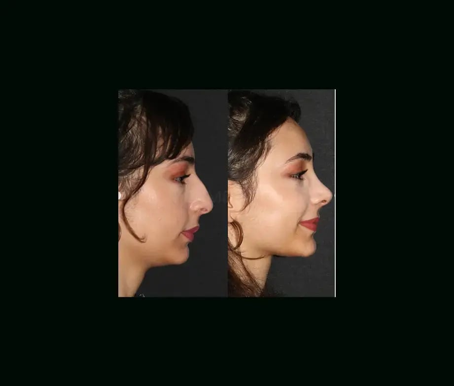mehmet-comert-md-rhinoplasty-before-after-1