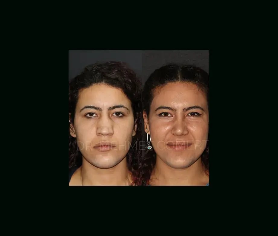 mehmet-comert-md-rhinoplasty-before-after-2