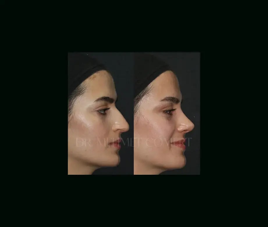 mehmet-comert-md-rhinoplasty-before-after-3