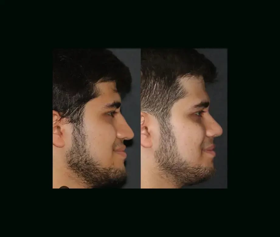 mehmet-comert-md-rhinoplasty-before-after-4