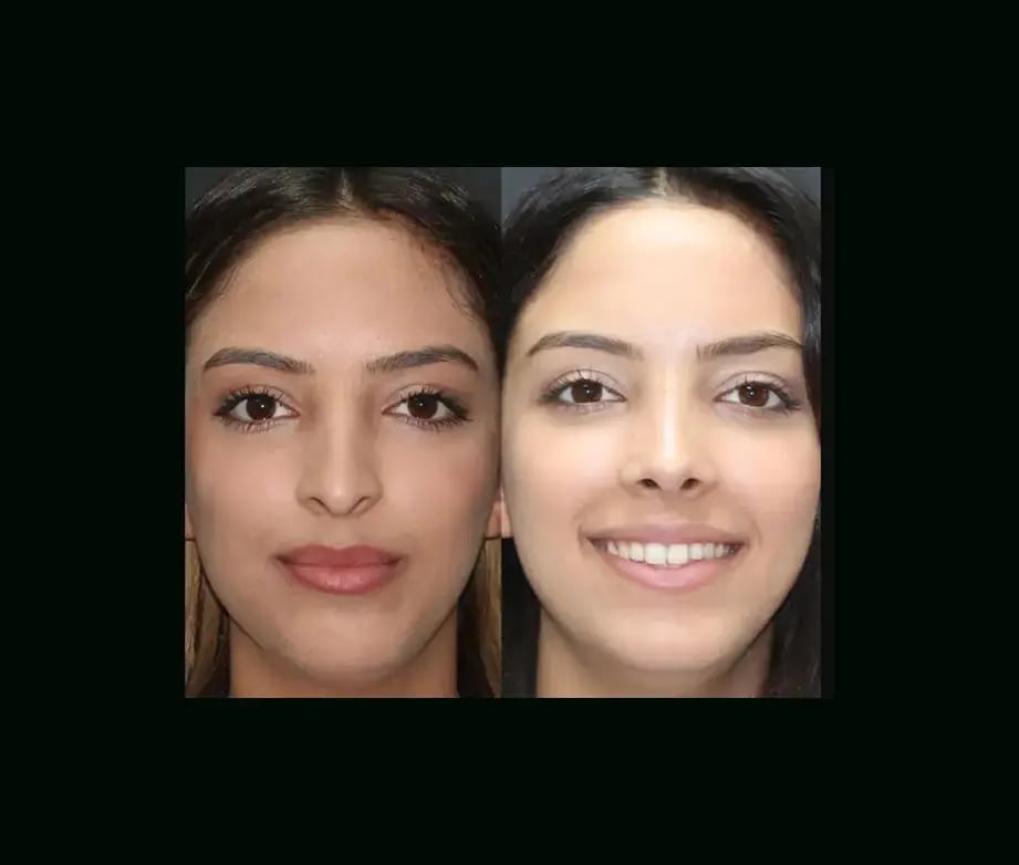 mehmet-comert-md-rhinoplasty-before-after-5