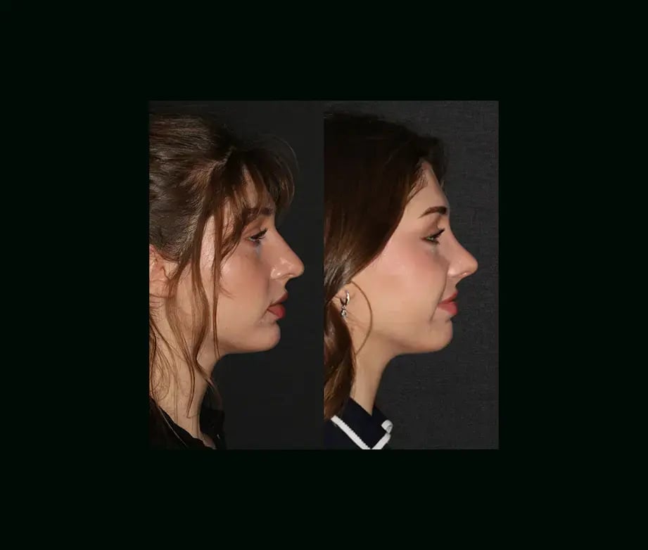mehmet-comert-md-rhinoplasty-before-after-6