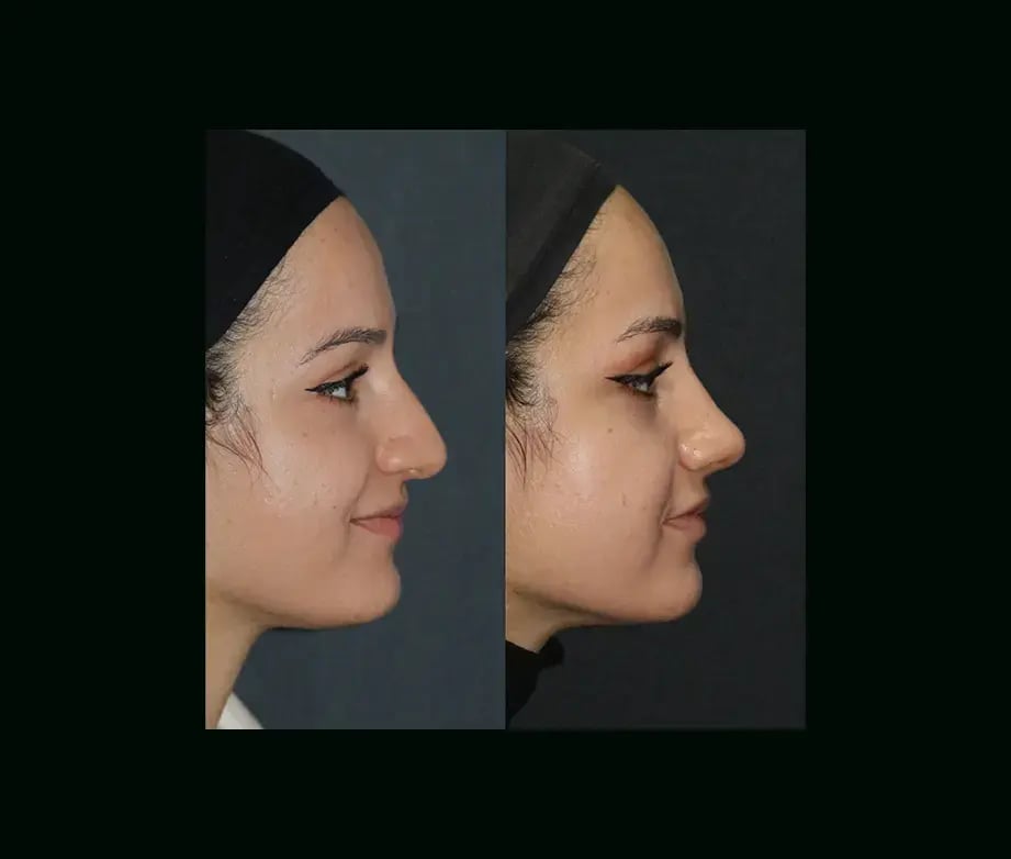 mehmet-comert-md-rhinoplasty-before-after-7
