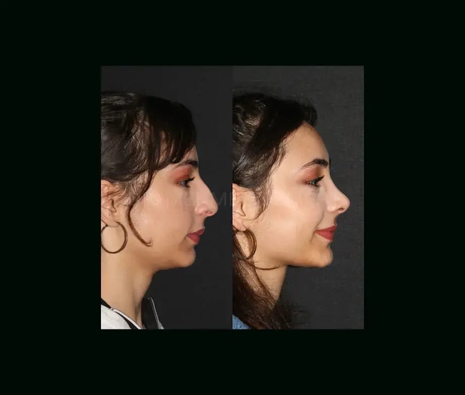 mehmet-comert-md-rhinoplasty-before-after-8